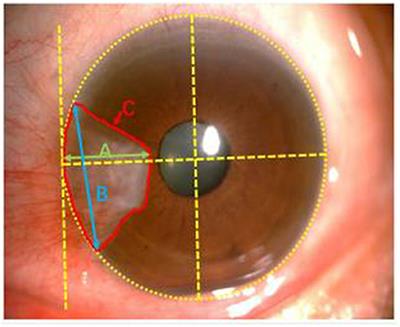 Decreased Macular Retinal Thickness in Patients With Pterygium